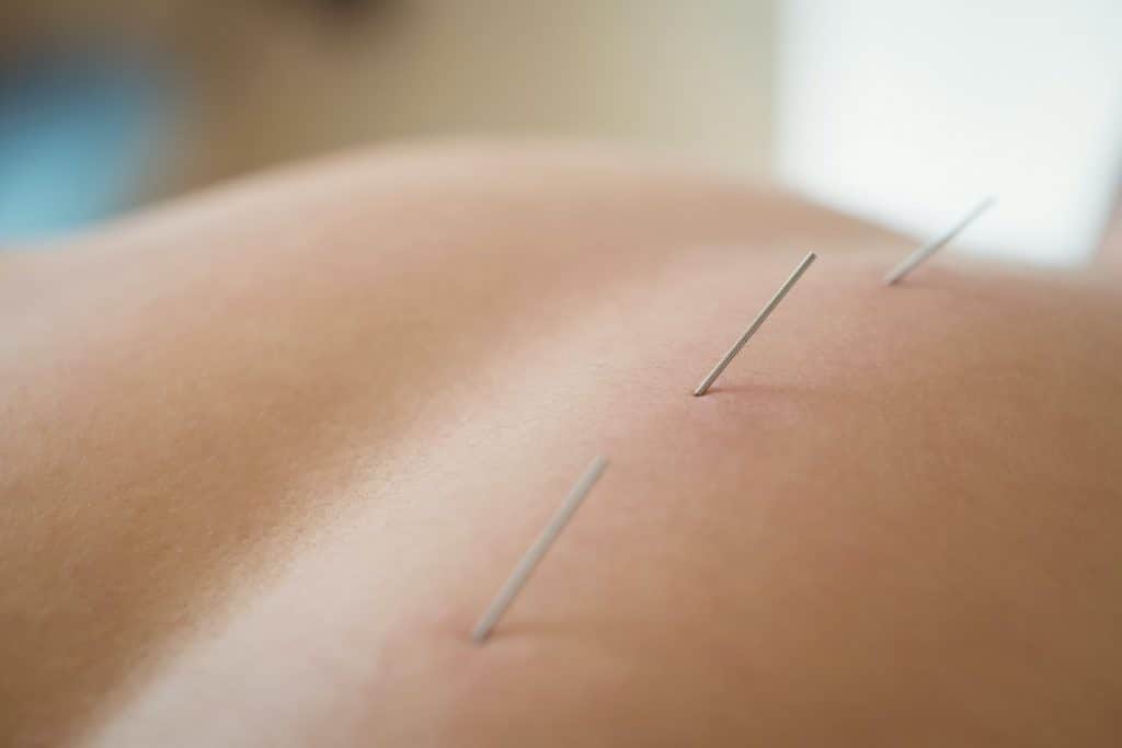 Eine Frau erhält Akupunkturbehandlung beim Osteopathen Hamburg.